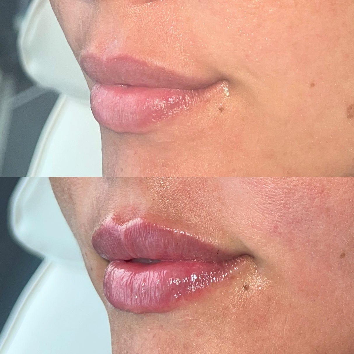 skin thesis clinic lurgan botox lip filler and dermal fillers